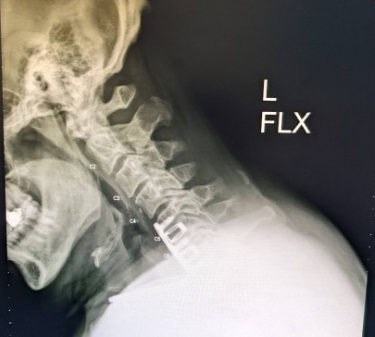 Name:  Neck X-Ray, L-Flex, Jun 2022 - cropped.jpg
Views: 543
Size:  30.2 KB